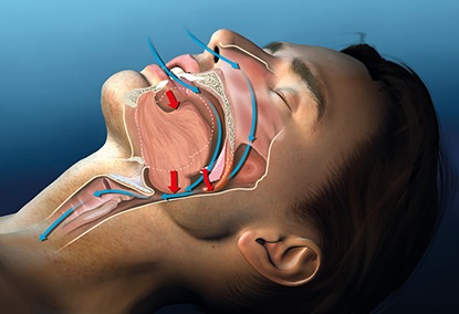 Diagram of airway obstruction during sleep