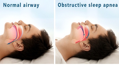 Model of airways with obstructive sleep apnea.